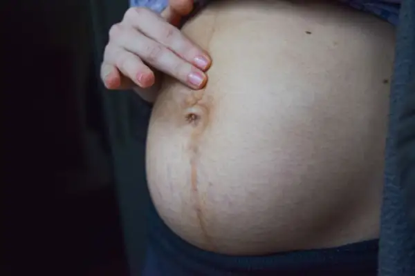 Dłoń dotyka brzucha z widoczną ciemną kreską na brzuchu w ciąży i rozstępami.