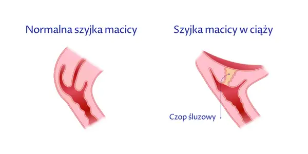 Czy krótka szyjka macicy ułatwia poród? Fakty, zagrożenia i porady dla kobiet w ciąży